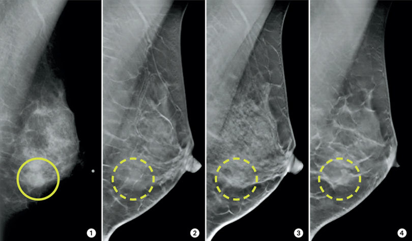 Who is doing saline breast inflation