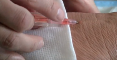 Needle in skin