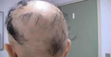 patient with Alopecia areata resulting in hair loss