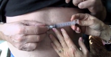 Feeding tube in woman's stomach