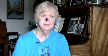 Cancer survivor without prosthetic nose