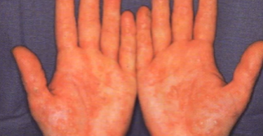 Hands of person with psoriasis