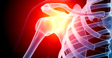 Shoulder x-ray highlighting pain