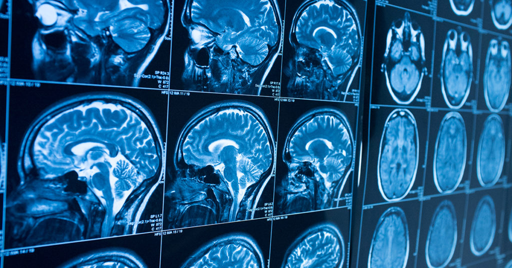 Do I need a brain scan to diagnose Alzheimer’s disease?