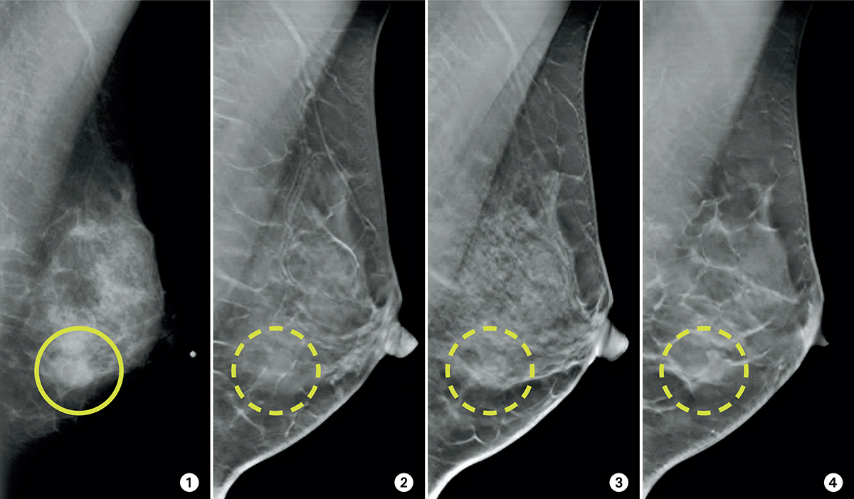  A mammogram image with a yellow circle highlighting a cancerous tumor in the breast.