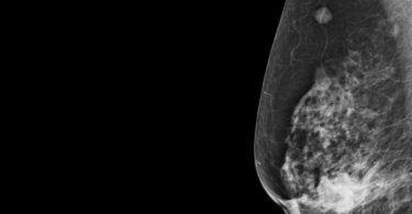 digital mammogram