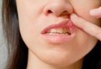 canker sore on upper lip