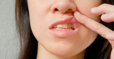 canker sore on upper lip