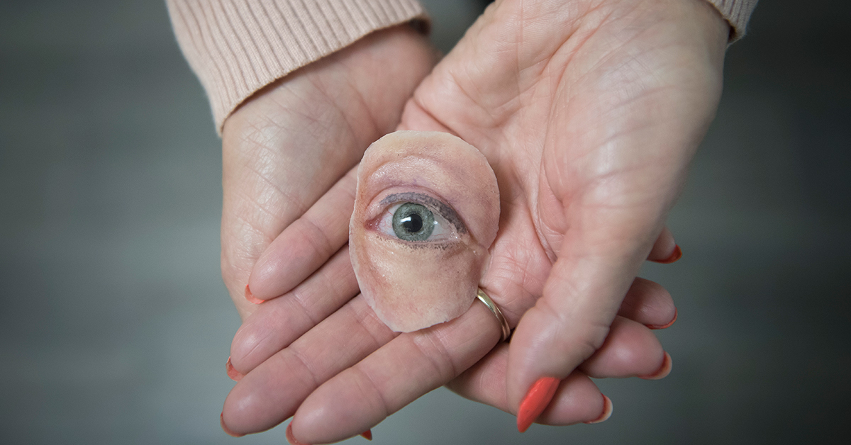 Brenda holding her prosthetic eye