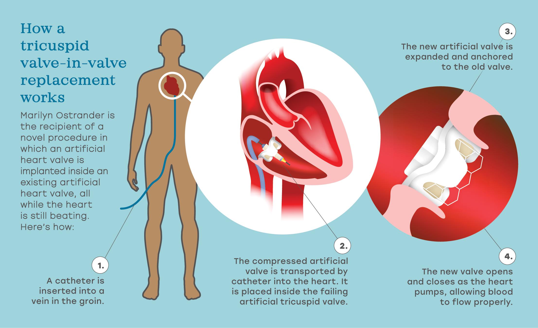 travel after heart valve replacement