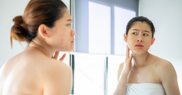 Woman looking at acne in the mirror
